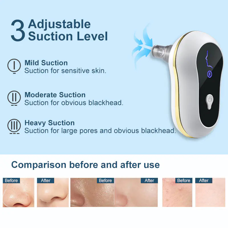 Electric Blackhead Remover with Ultrasonic Technology